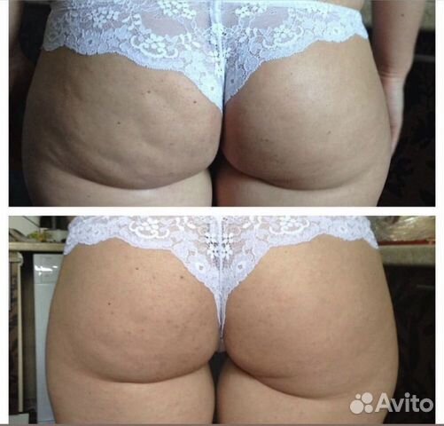 Антицеллюлитный массаж и коррекция фигуры