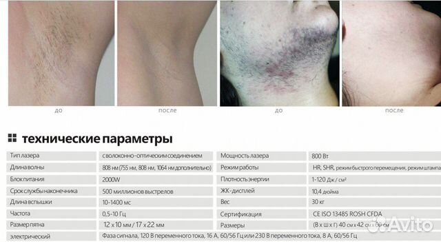 Лазер для эпиляции