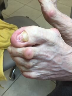 Медицинский педикюр